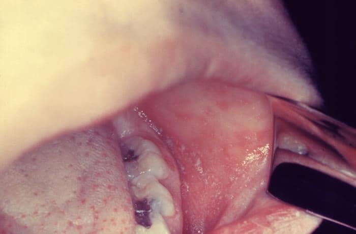 Timeline gejala campak dari hari ke hari